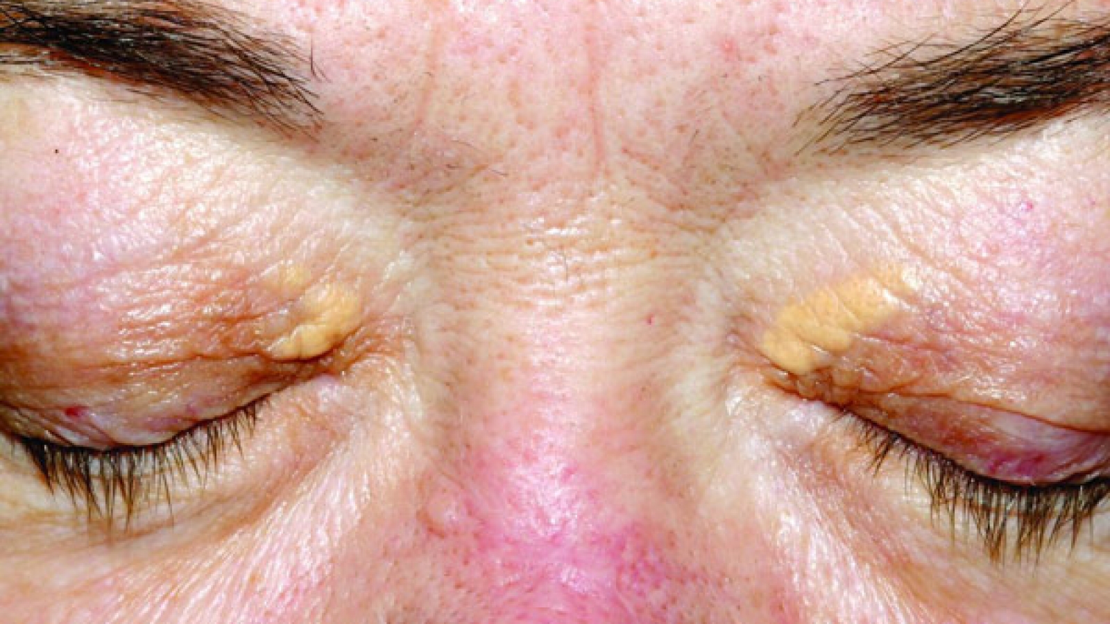 Operacije-ksantelazmi_mob