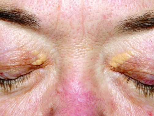 Operacije-ksantelazmi_mob