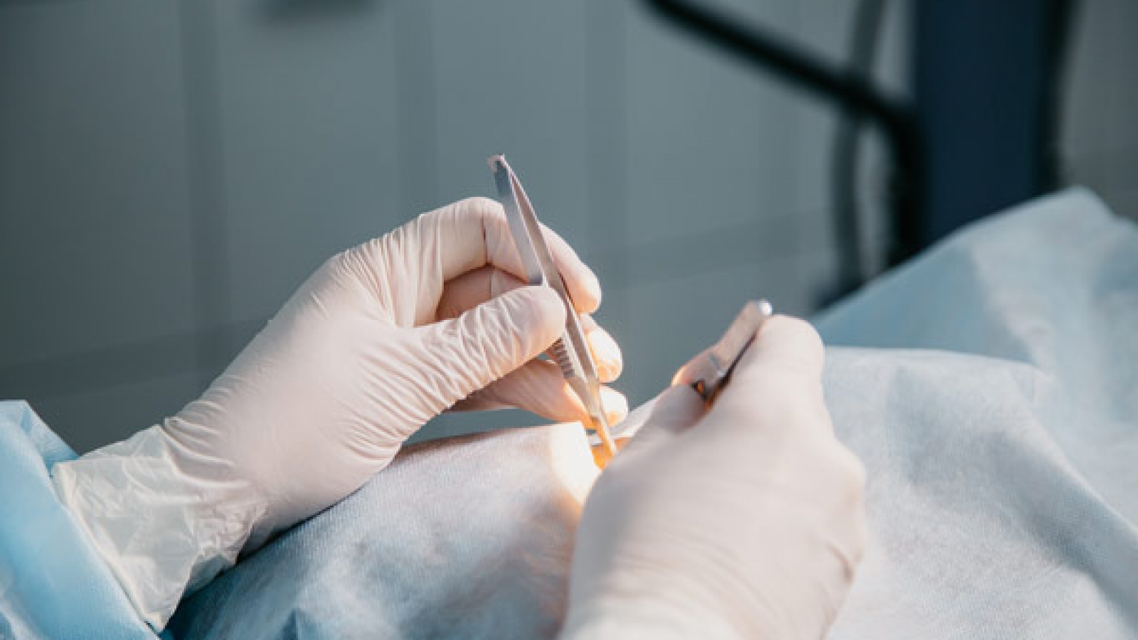 Operacije-pterigija,-nevusa-i-melanoza-spojnice_mob