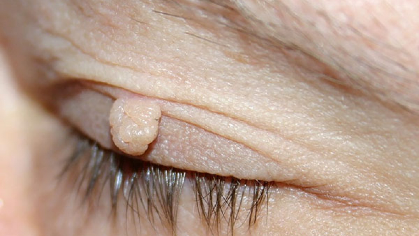 Operacije-tumora-vjeđa_mob