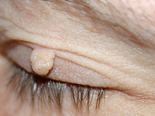 Operacije-tumora-vjeđa_mob