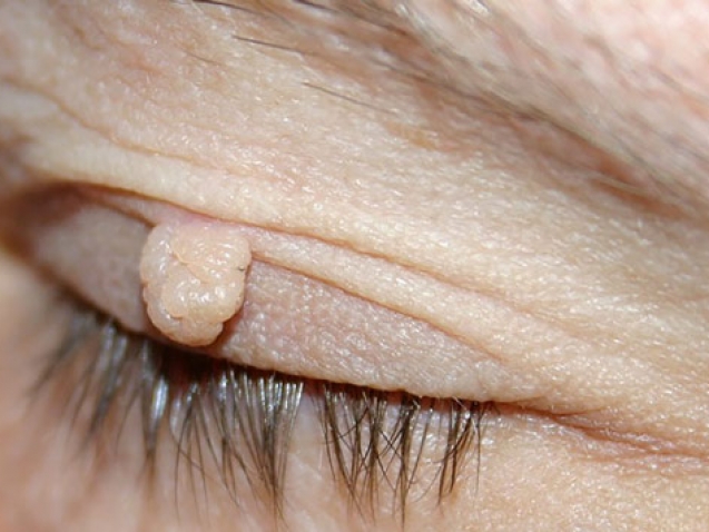 Home 44 Operacije-tumora-vjeđa_mob