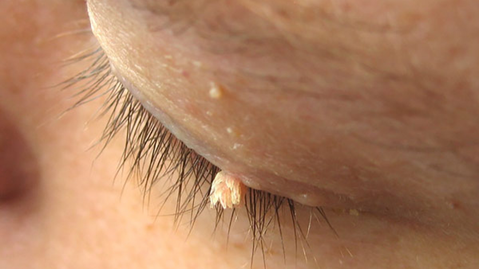 Operacije-virusnih-bradavica-i-fibroma_mob