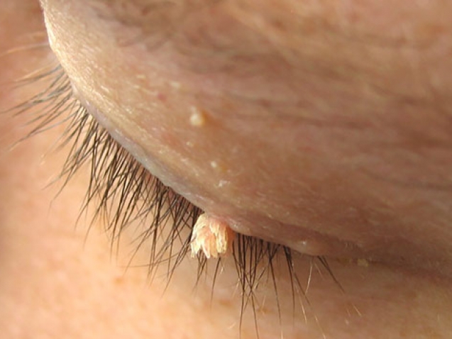 Home 52 Operacije-virusnih-bradavica-i-fibroma_mob